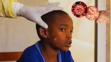 First case new monkeypox strain