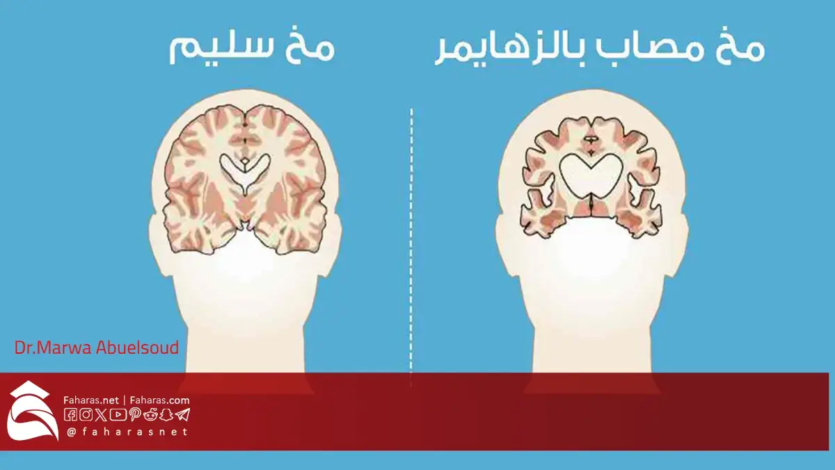 دواء كيسونلا لعلاج مرض الزهايمر