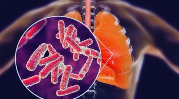 tuberculosis recurrence