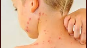 Measles Morocco has become epidemic